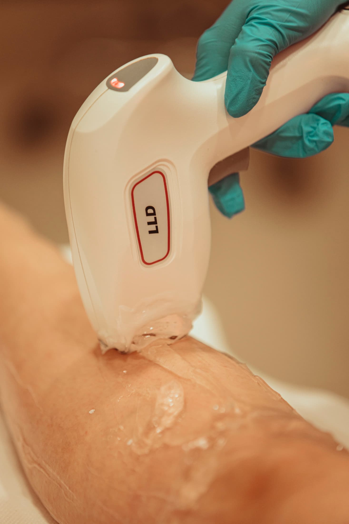 Épilation laser